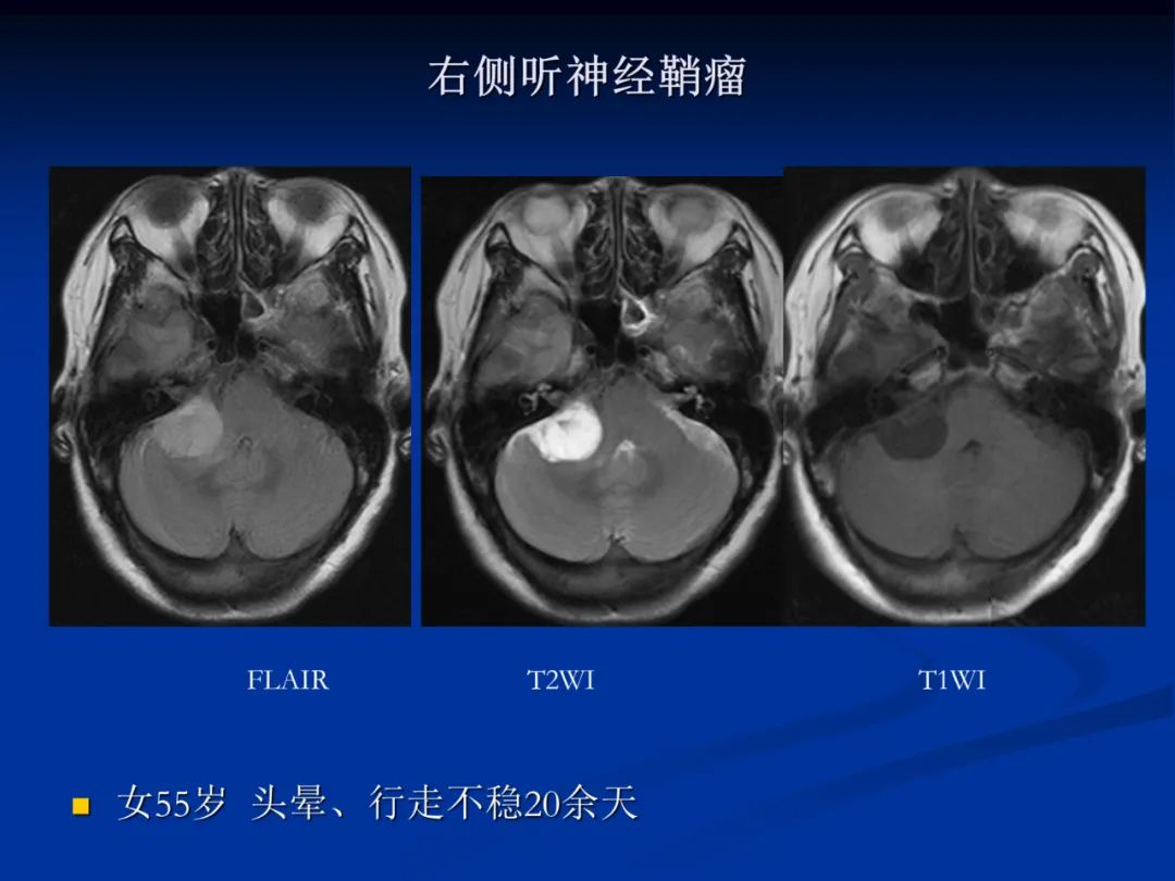 影像PPT - 【PPT】脑肿瘤影像学诊断-105