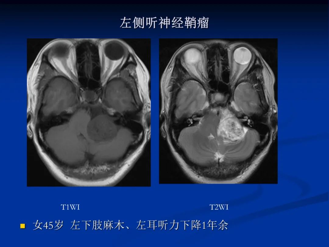 影像PPT - 【PPT】脑肿瘤影像学诊断-107