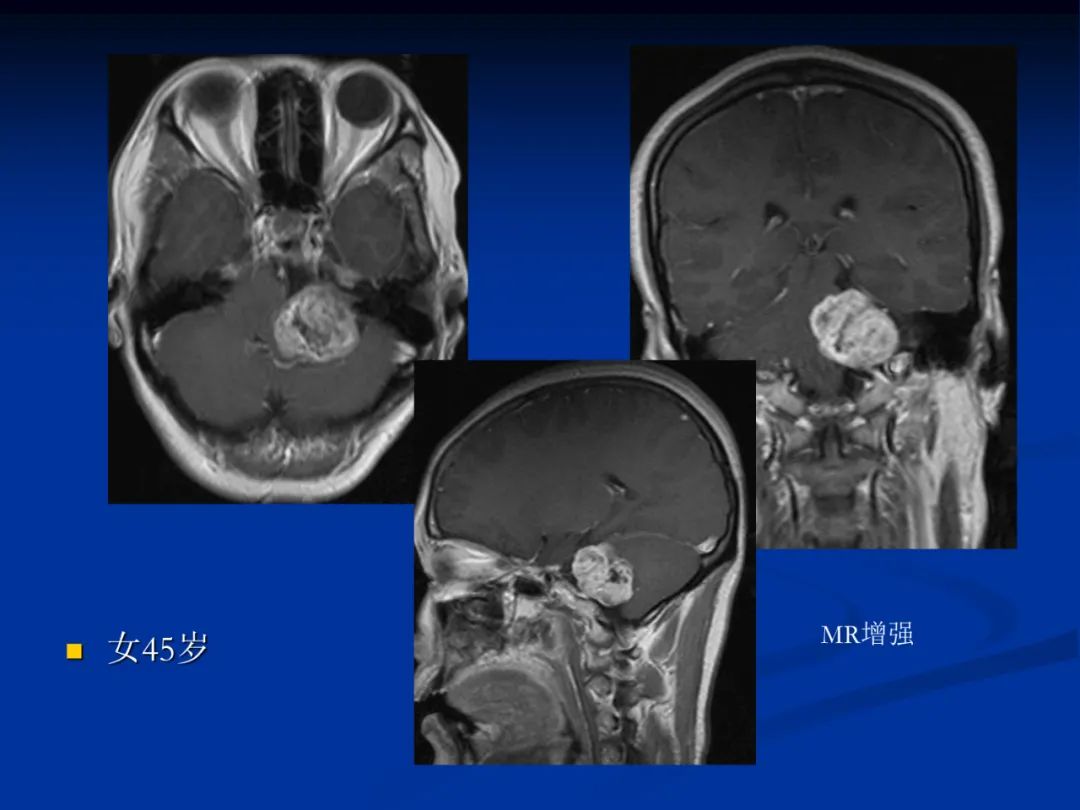 影像PPT - 【PPT】脑肿瘤影像学诊断-108