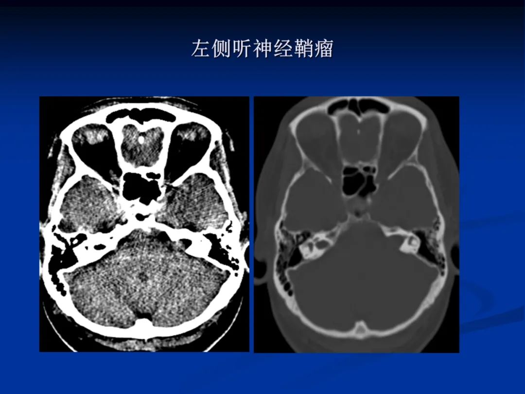 影像PPT - 【PPT】脑肿瘤影像学诊断-109