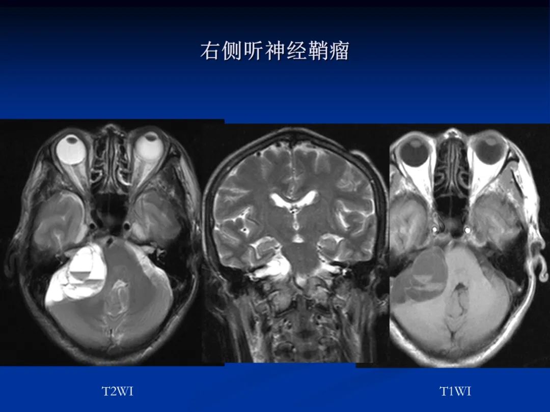 影像PPT - 【PPT】脑肿瘤影像学诊断-110