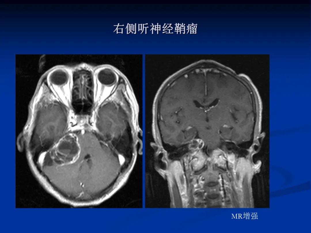 影像PPT - 【PPT】脑肿瘤影像学诊断-111