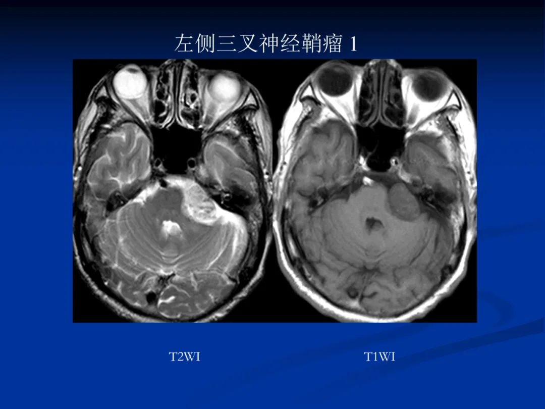 影像PPT - 【PPT】脑肿瘤影像学诊断-113