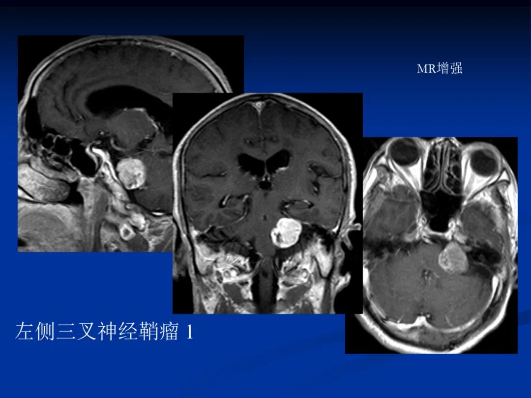 影像PPT - 【PPT】脑肿瘤影像学诊断-114