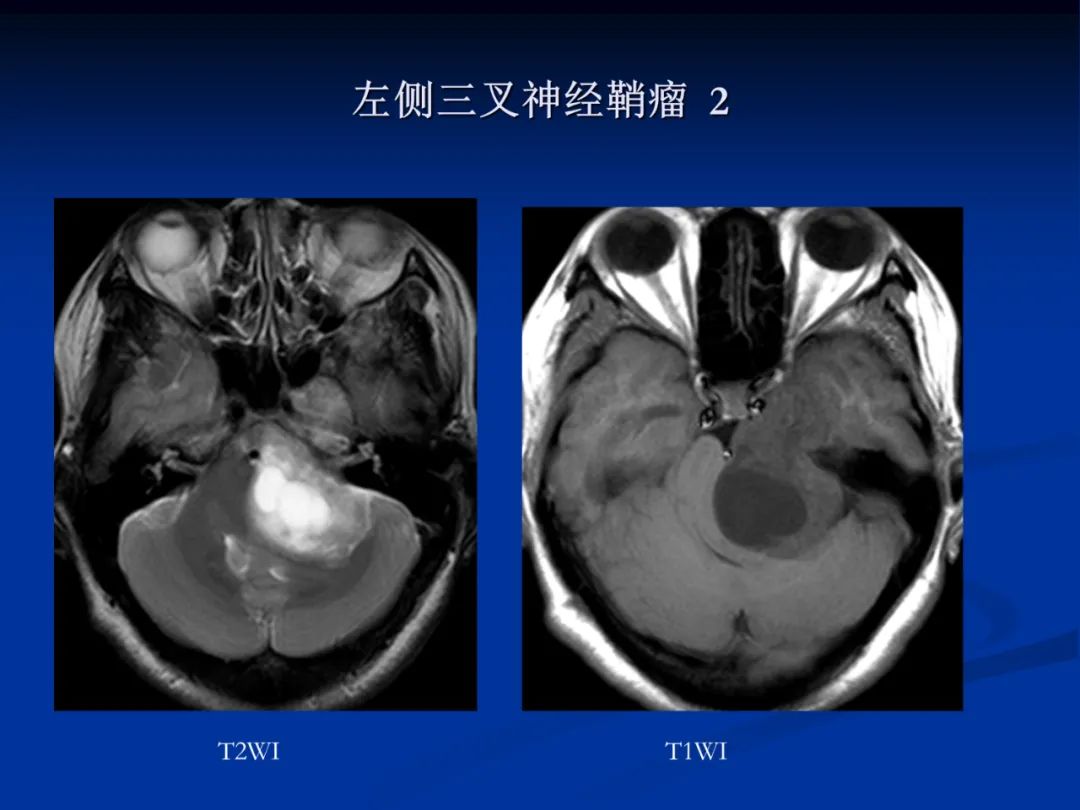 影像PPT - 【PPT】脑肿瘤影像学诊断-115