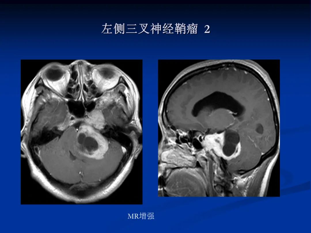 影像PPT - 【PPT】脑肿瘤影像学诊断-116