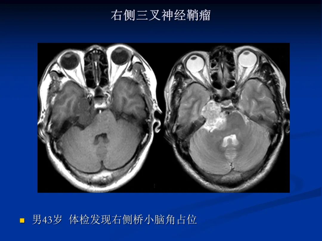 影像PPT - 【PPT】脑肿瘤影像学诊断-117