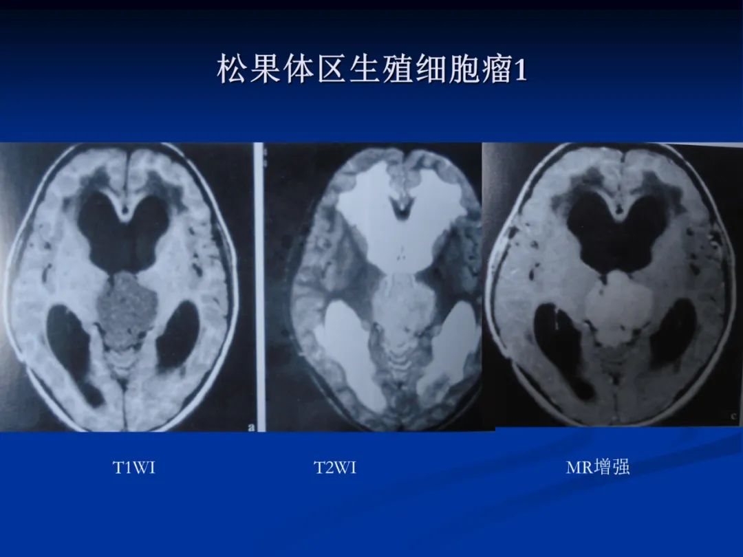 影像PPT - 【PPT】脑肿瘤影像学诊断-120