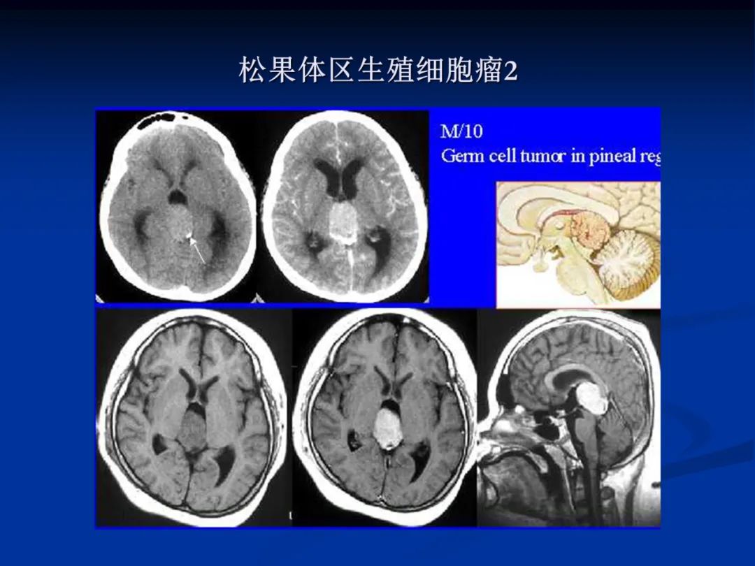 影像PPT - 【PPT】脑肿瘤影像学诊断-121
