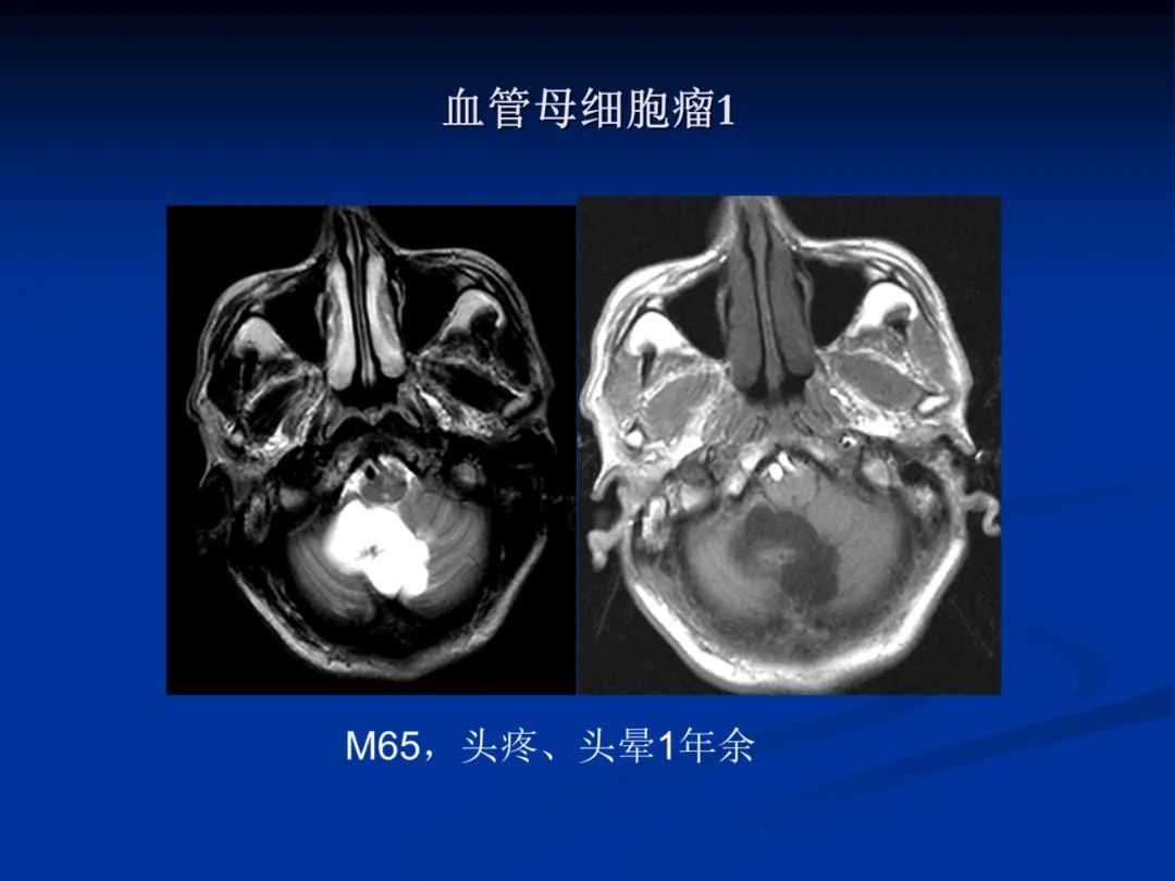 影像PPT - 【PPT】脑肿瘤影像学诊断-123