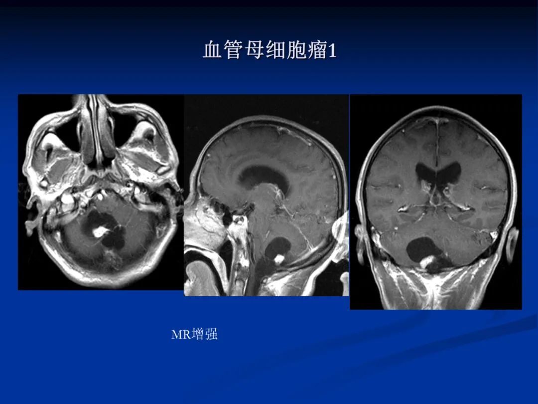 影像PPT - 【PPT】脑肿瘤影像学诊断-124
