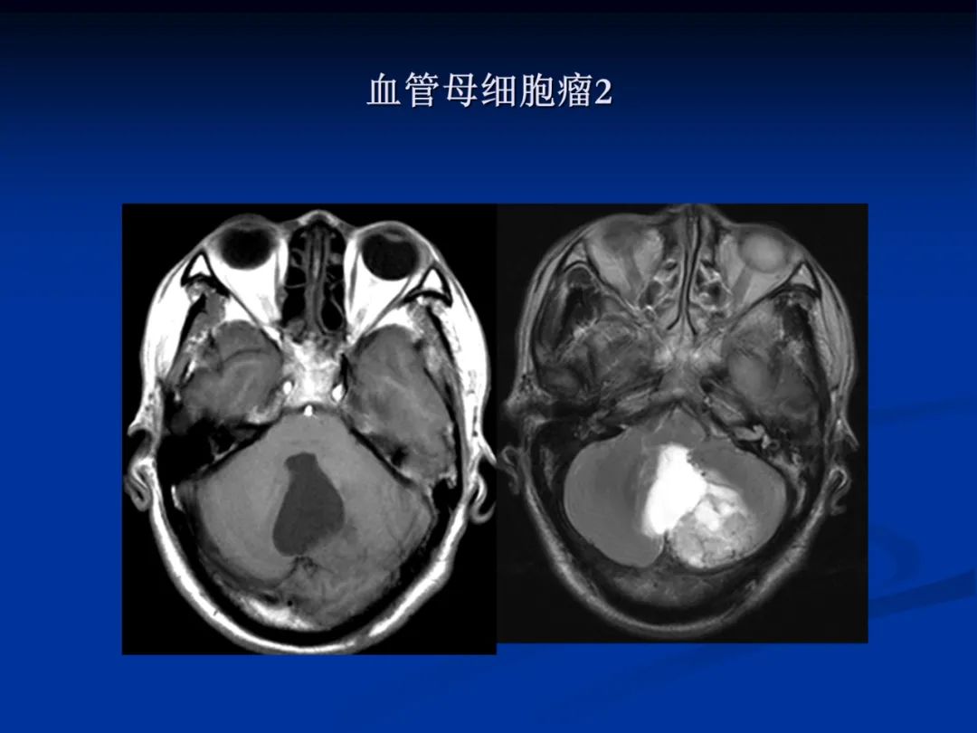 影像PPT - 【PPT】脑肿瘤影像学诊断-125