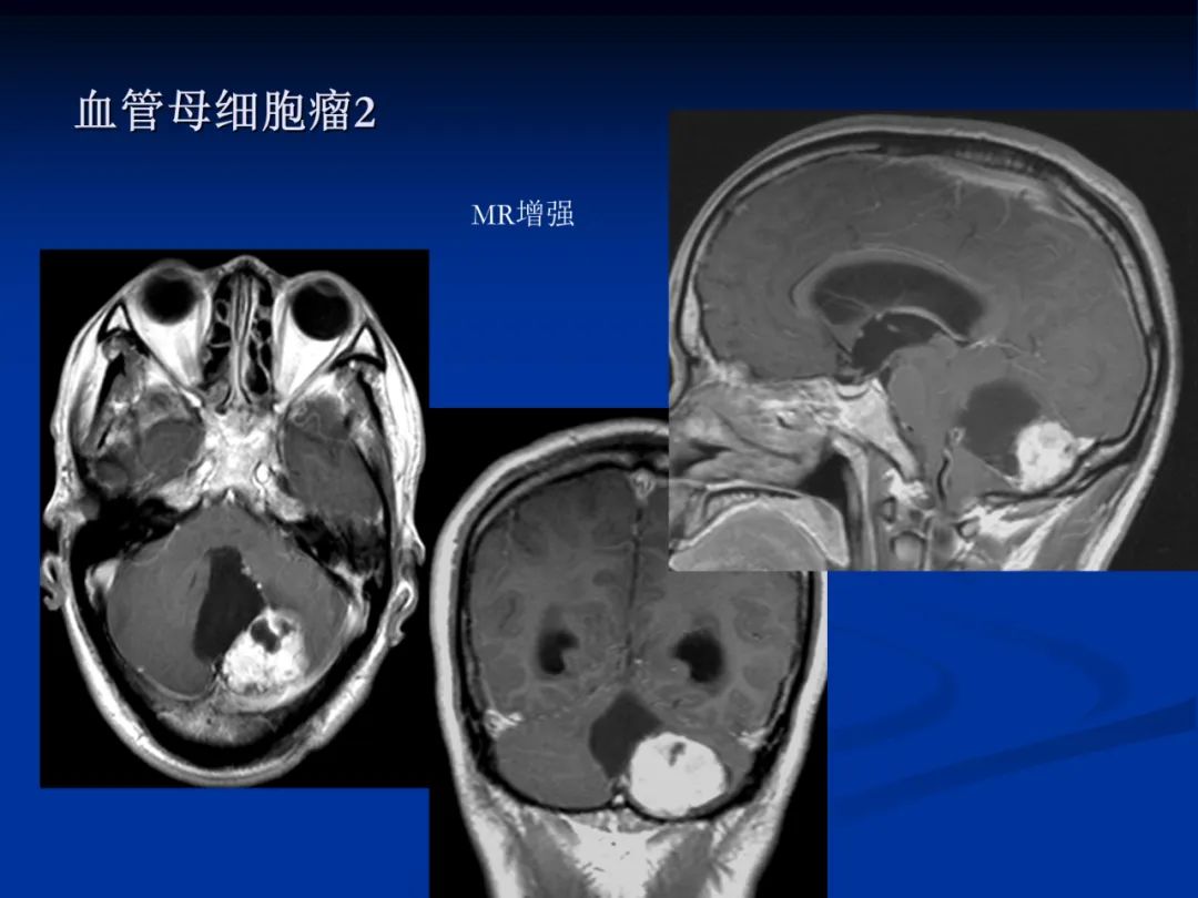影像PPT - 【PPT】脑肿瘤影像学诊断-126