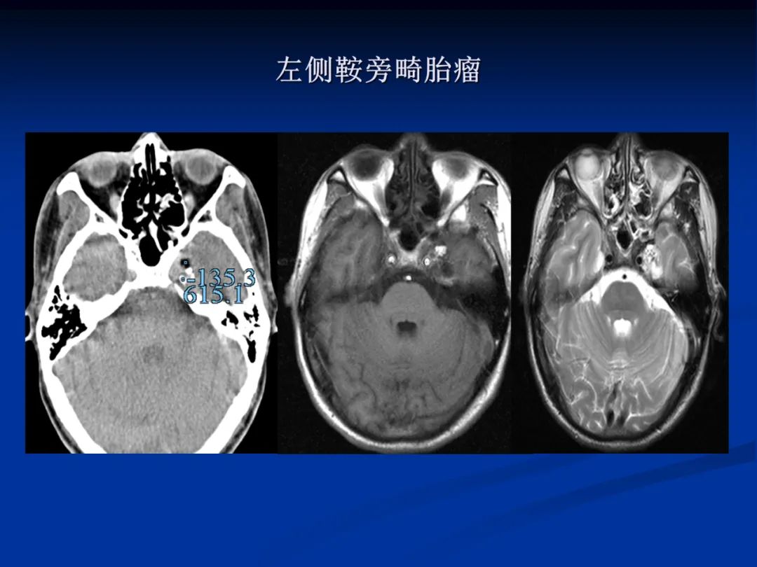 影像PPT - 【PPT】脑肿瘤影像学诊断-127