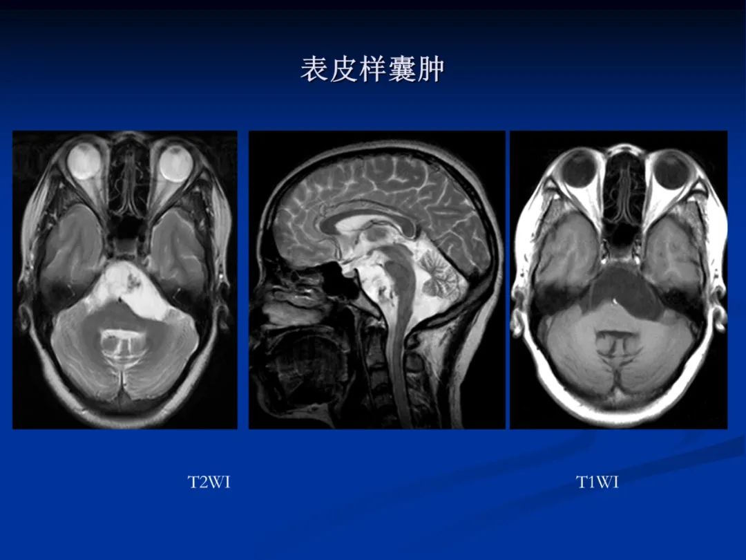 影像PPT - 【PPT】脑肿瘤影像学诊断-128