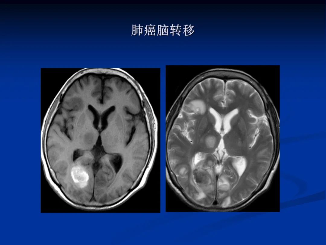 影像PPT - 【PPT】脑肿瘤影像学诊断-130