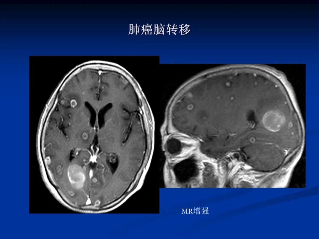 影像PPT - 【PPT】脑肿瘤影像学诊断-131
