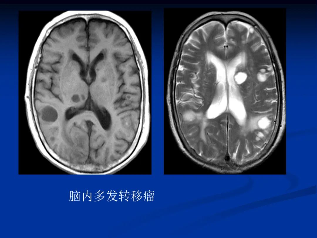 影像PPT - 【PPT】脑肿瘤影像学诊断-132