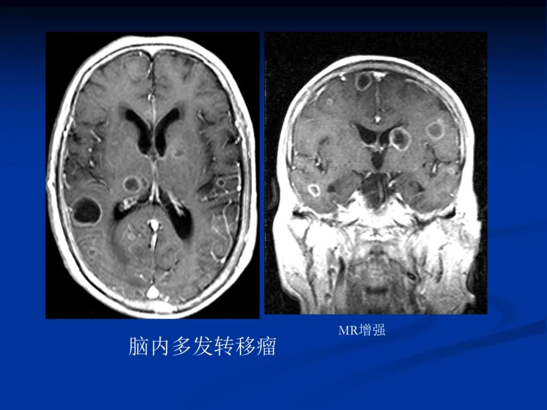 影像PPT - 【PPT】脑肿瘤影像学诊断-133