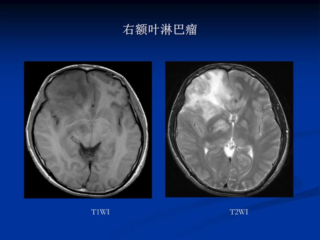 影像PPT - 【PPT】脑肿瘤影像学诊断-135