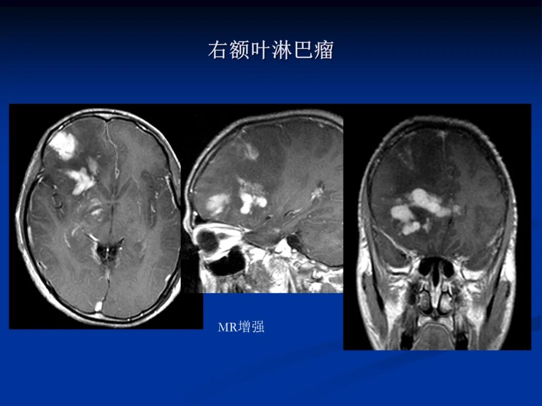 影像PPT - 【PPT】脑肿瘤影像学诊断-136