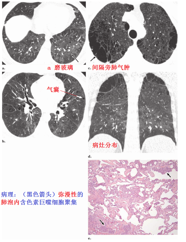 影像PPT - 吸烟相关性间质性肺疾病-4 影像PPT - 吸烟相关性间质性肺疾病-4