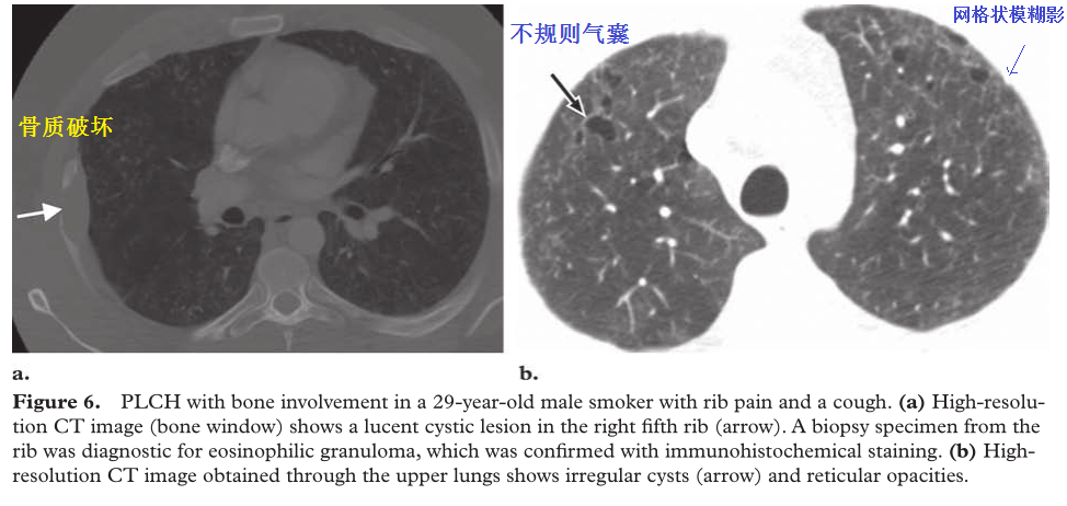影像PPT - 吸烟相关性间质性肺疾病-12 影像PPT - 吸烟相关性间质性肺疾病-12