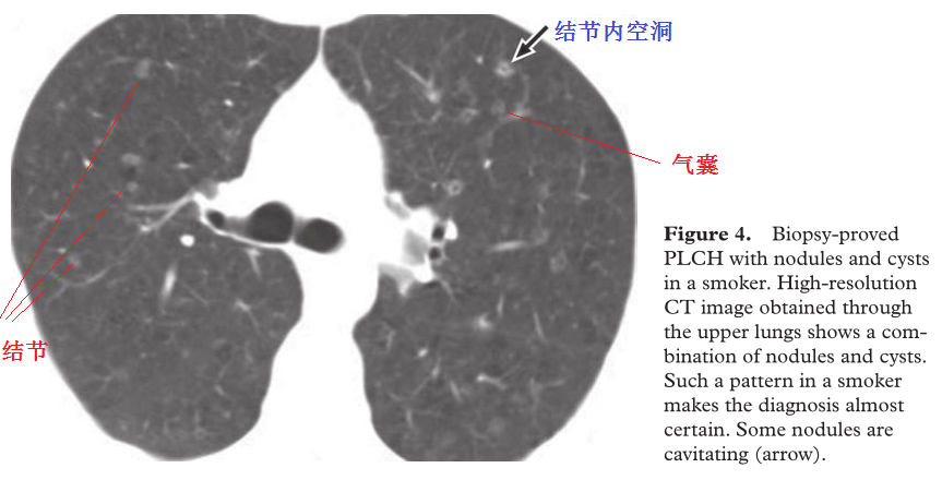 影像PPT - 吸烟相关性间质性肺疾病-8 影像PPT - 吸烟相关性间质性肺疾病-8