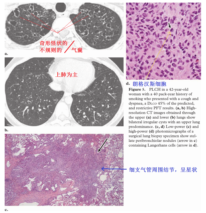 影像PPT - 吸烟相关性间质性肺疾病-10 影像PPT - 吸烟相关性间质性肺疾病-10