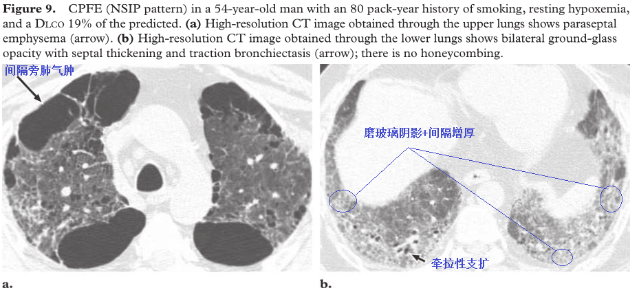影像PPT - 吸烟相关性间质性肺疾病-18 影像PPT - 吸烟相关性间质性肺疾病-18
