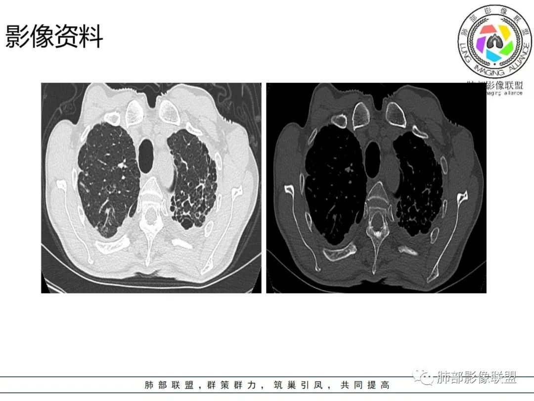 影像PPT - 【病例】 结核与非结核分枝杆菌感染-3 影像PPT - 【病例】 结核与非结核分枝杆菌感染-3