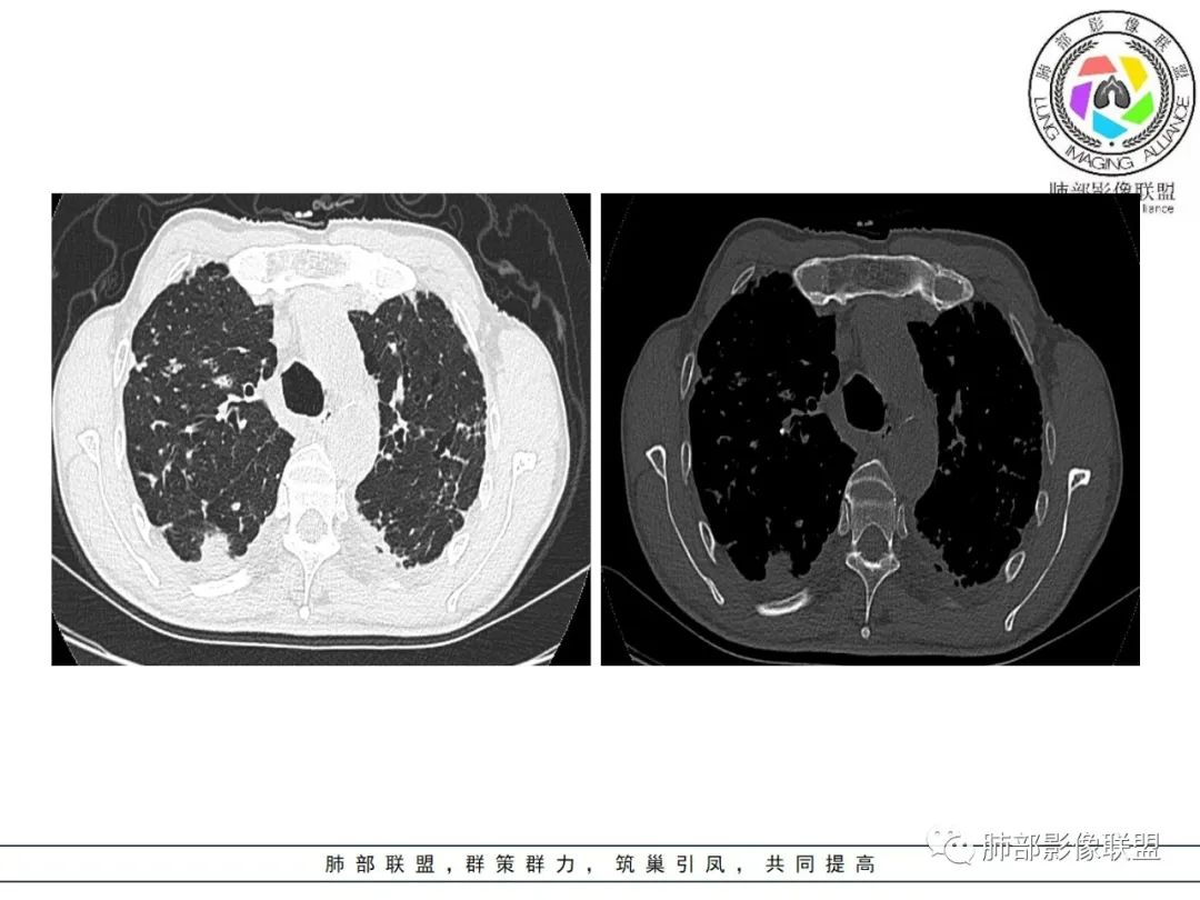 影像PPT - 【病例】 结核与非结核分枝杆菌感染-4 影像PPT - 【病例】 结核与非结核分枝杆菌感染-4