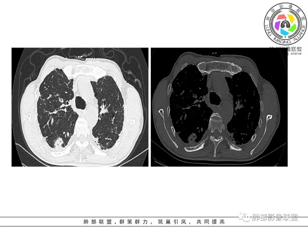 影像PPT - 【病例】 结核与非结核分枝杆菌感染-5 影像PPT - 【病例】 结核与非结核分枝杆菌感染-5