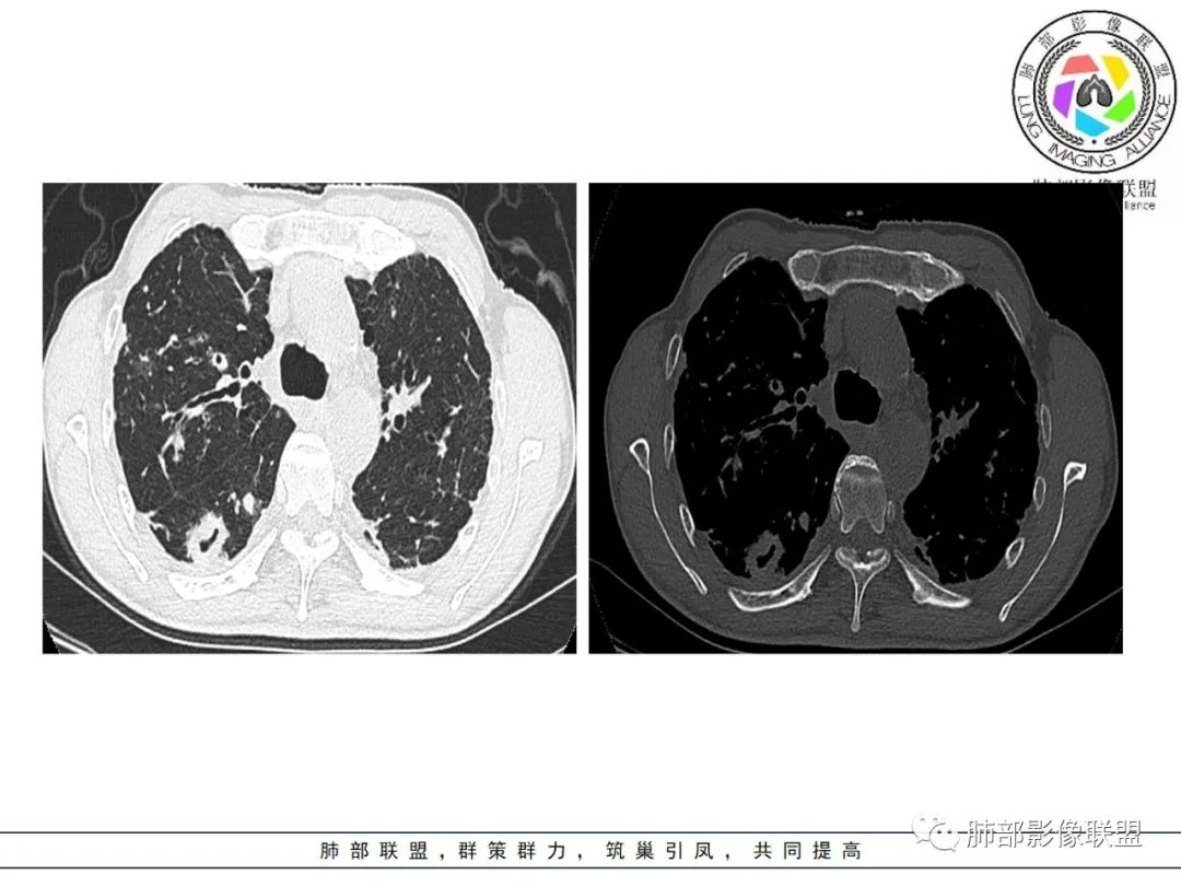 影像PPT - 【病例】 结核与非结核分枝杆菌感染-6 影像PPT - 【病例】 结核与非结核分枝杆菌感染-6