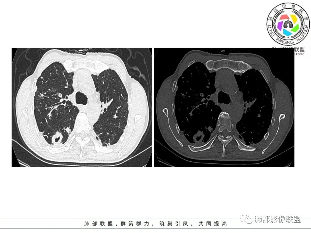 影像PPT - 【病例】 结核与非结核分枝杆菌感染-7 影像PPT - 【病例】 结核与非结核分枝杆菌感染-7