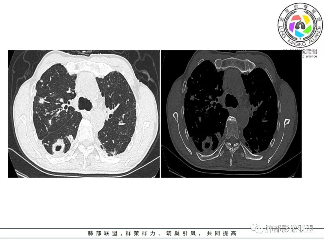 影像PPT - 【病例】 结核与非结核分枝杆菌感染-8 影像PPT - 【病例】 结核与非结核分枝杆菌感染-8