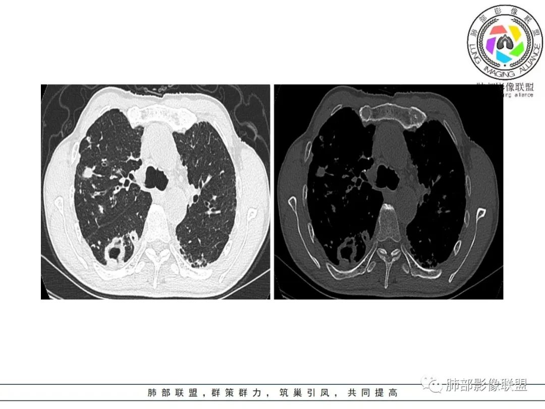 影像PPT - 【病例】 结核与非结核分枝杆菌感染-9 影像PPT - 【病例】 结核与非结核分枝杆菌感染-9