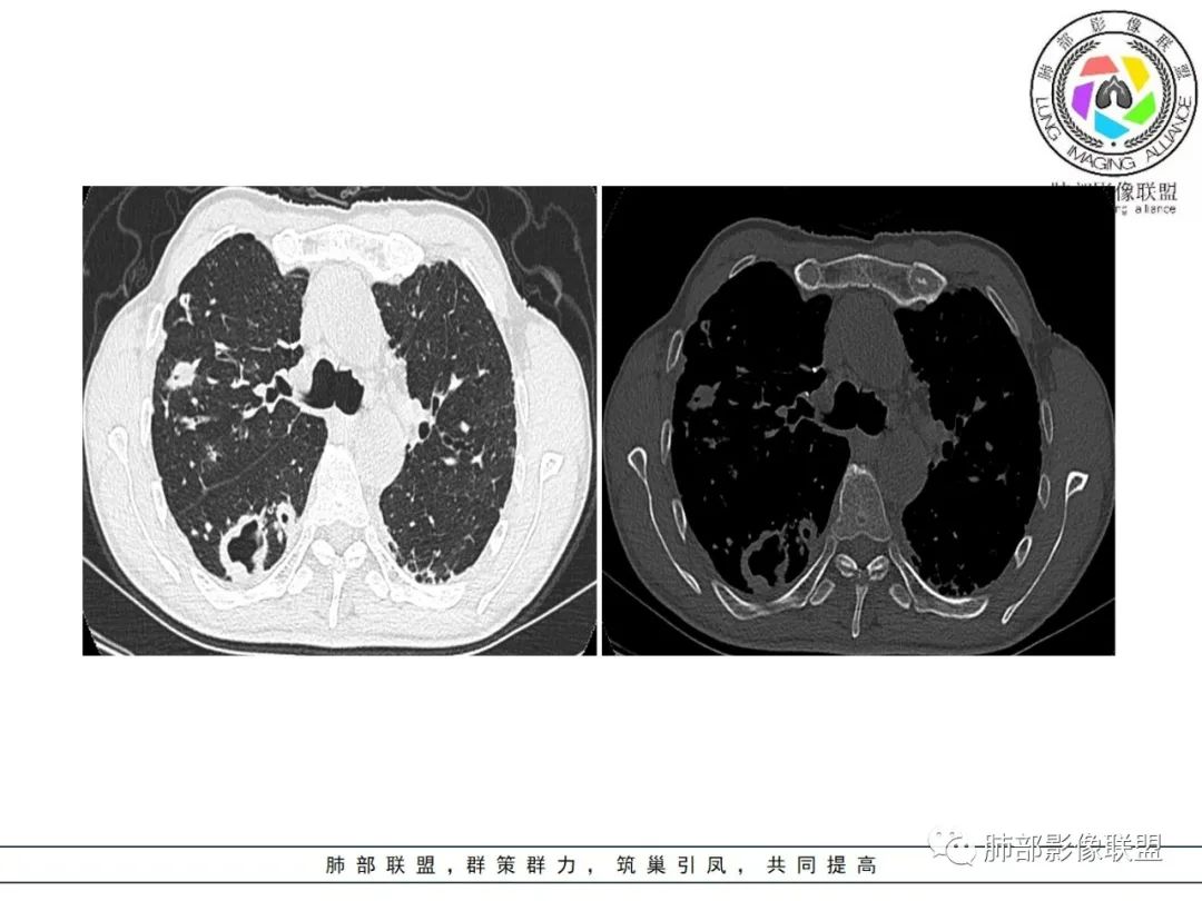 影像PPT - 【病例】 结核与非结核分枝杆菌感染-10 影像PPT - 【病例】 结核与非结核分枝杆菌感染-10