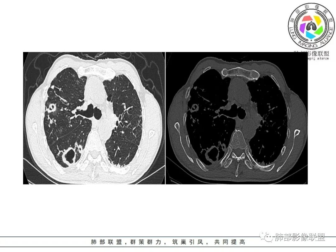 影像PPT - 【病例】 结核与非结核分枝杆菌感染-11 影像PPT - 【病例】 结核与非结核分枝杆菌感染-11