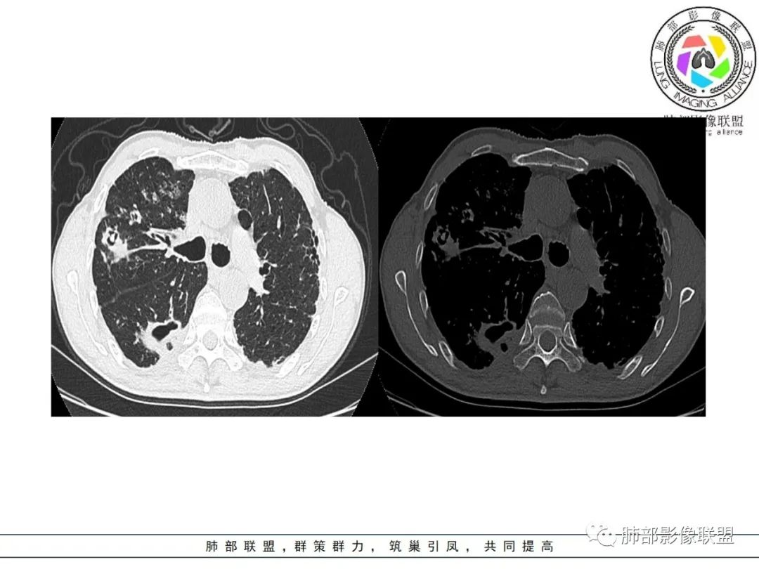 影像PPT - 【病例】 结核与非结核分枝杆菌感染-12 影像PPT - 【病例】 结核与非结核分枝杆菌感染-12