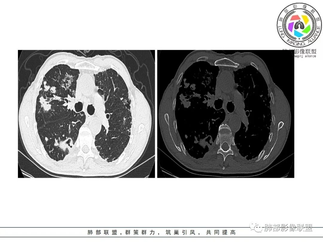 影像PPT - 【病例】 结核与非结核分枝杆菌感染-13 影像PPT - 【病例】 结核与非结核分枝杆菌感染-13
