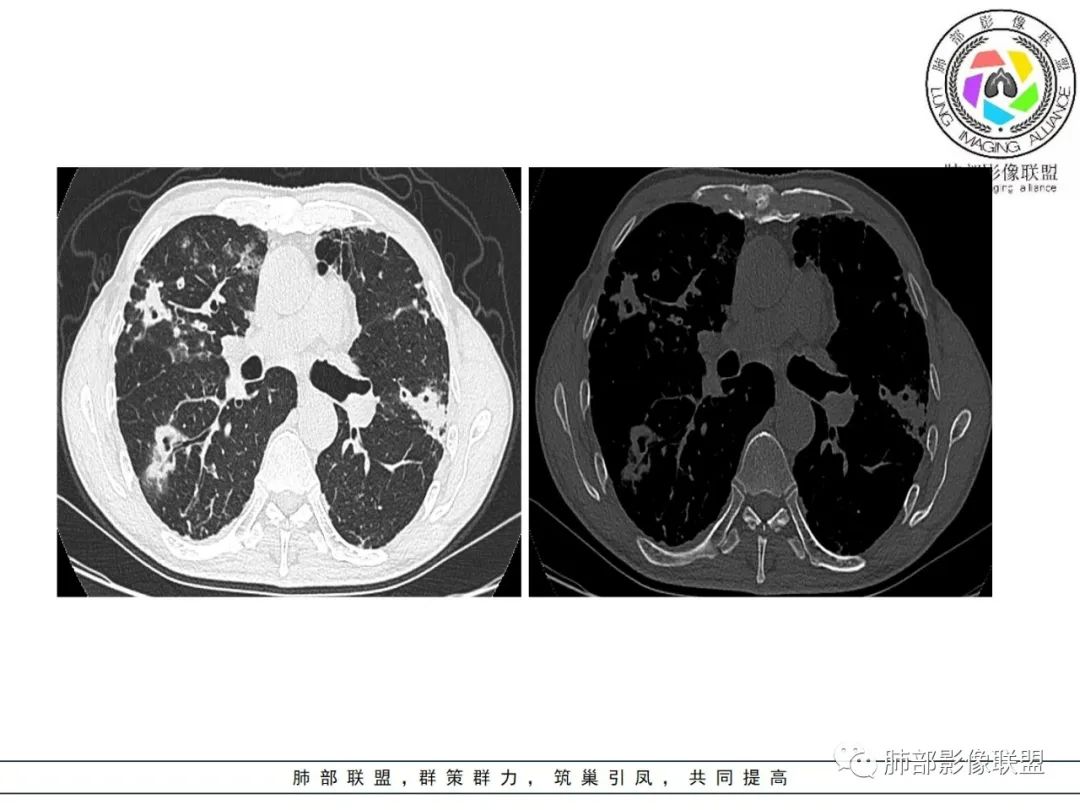 影像PPT - 【病例】 结核与非结核分枝杆菌感染-14 影像PPT - 【病例】 结核与非结核分枝杆菌感染-14