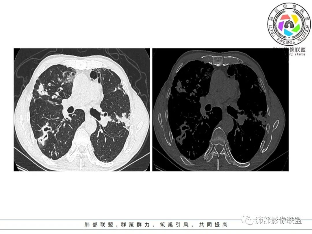 影像PPT - 【病例】 结核与非结核分枝杆菌感染-15 影像PPT - 【病例】 结核与非结核分枝杆菌感染-15