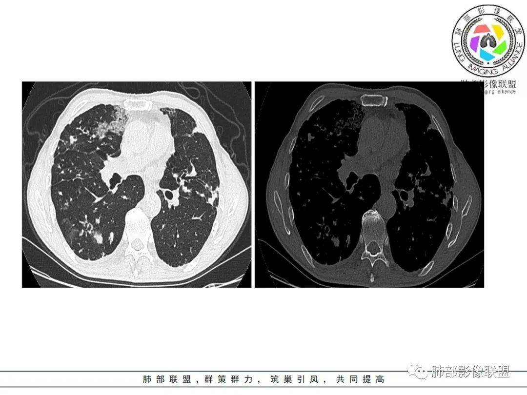 影像PPT - 【病例】 结核与非结核分枝杆菌感染-16 影像PPT - 【病例】 结核与非结核分枝杆菌感染-16