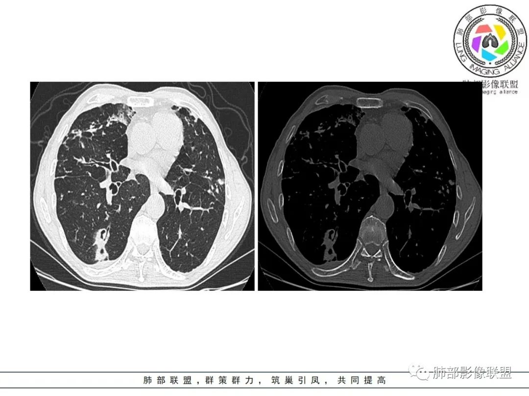 影像PPT - 【病例】 结核与非结核分枝杆菌感染-18 影像PPT - 【病例】 结核与非结核分枝杆菌感染-18