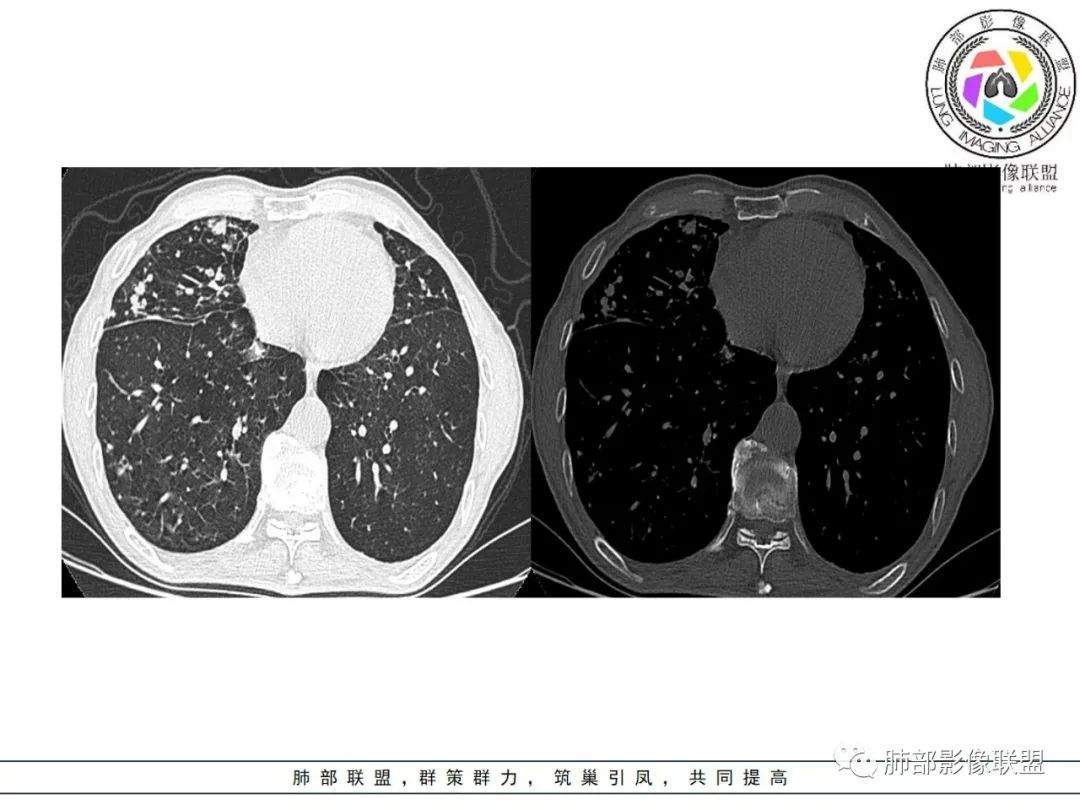 影像PPT - 【病例】 结核与非结核分枝杆菌感染-19 影像PPT - 【病例】 结核与非结核分枝杆菌感染-19