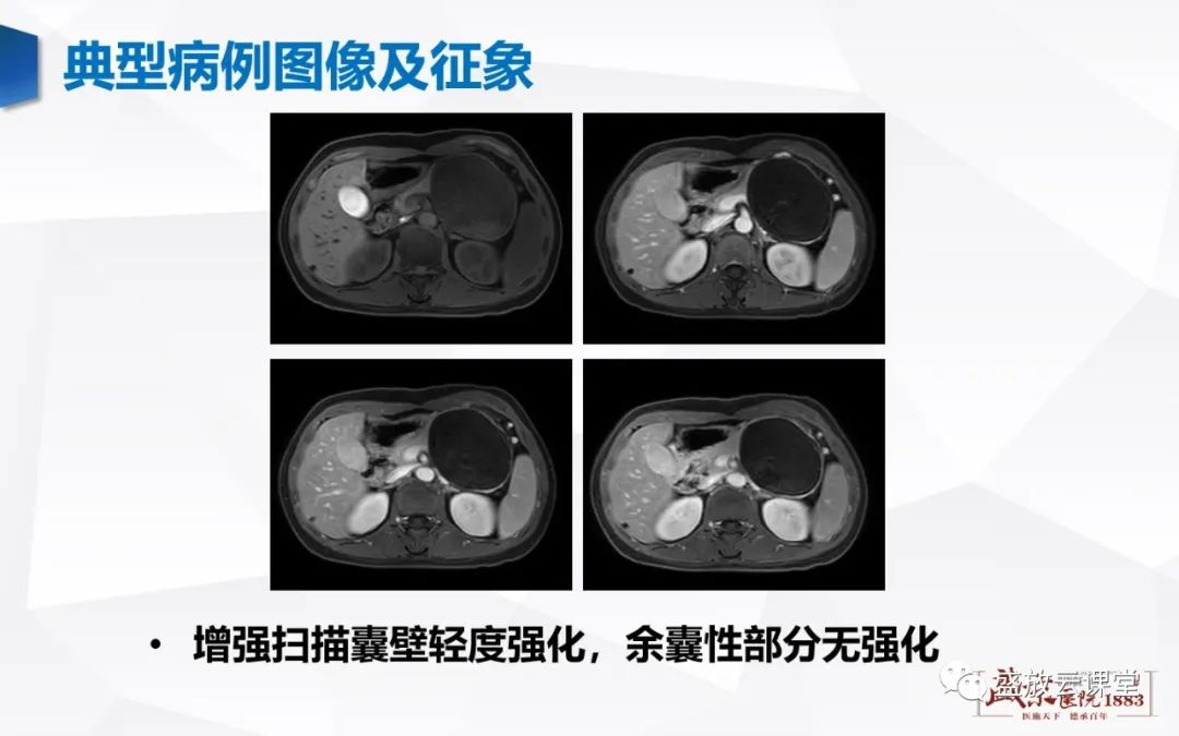 影像PPT - 【病例】胰腺囊腺瘤2例—浆液性 VS 粘液性-15 影像PPT - 【病例】胰腺囊腺瘤2例—浆液性 VS 粘液性-15
