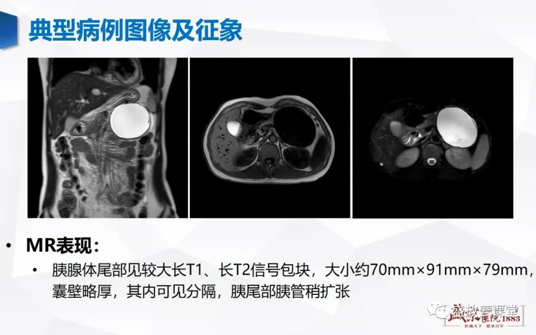 影像PPT - 【病例】胰腺囊腺瘤2例—浆液性 VS 粘液性-14 影像PPT - 【病例】胰腺囊腺瘤2例—浆液性 VS 粘液性-14