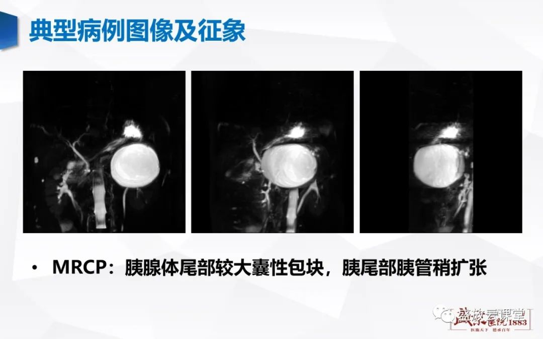 影像PPT - 【病例】胰腺囊腺瘤2例—浆液性 VS 粘液性-16 影像PPT - 【病例】胰腺囊腺瘤2例—浆液性 VS 粘液性-16