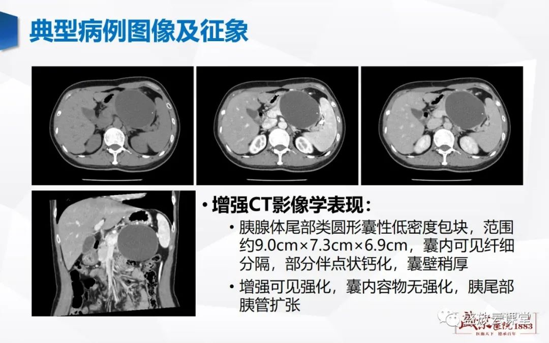 影像PPT - 【病例】胰腺囊腺瘤2例—浆液性 VS 粘液性-12 影像PPT - 【病例】胰腺囊腺瘤2例—浆液性 VS 粘液性-12